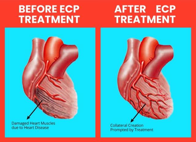 EECP B+A-01.jpg